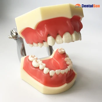 Zobu Periodonta Slimību Modelis M4024/Medicīnas Zobu Ārstēšanas Modelis